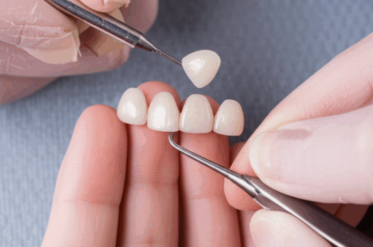 Can You Get Veneers Without Being a Dentist The Risks Regulations and Realities