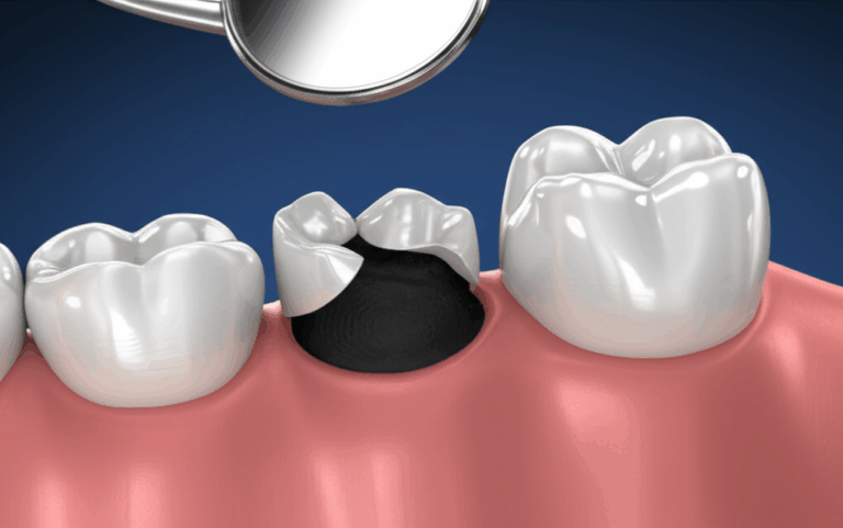 Why Do Dentists Put Crowns on Teeth Essential Reasons for Tooth Repair